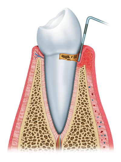 Stages of Gum Disease Murfressboro, TN