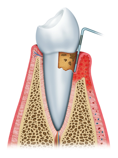 Stages of Gum Disease Murfressboro, TN