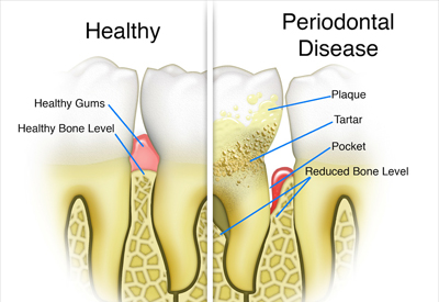 Gum Disease and Tooth and Bone Loss Murfressboro, TN