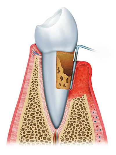 Stages of Gum Disease Murfressboro, TN