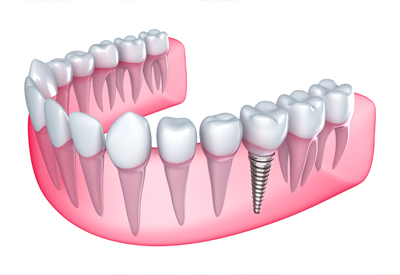 Single Missing Tooth in Murfressboro, TN