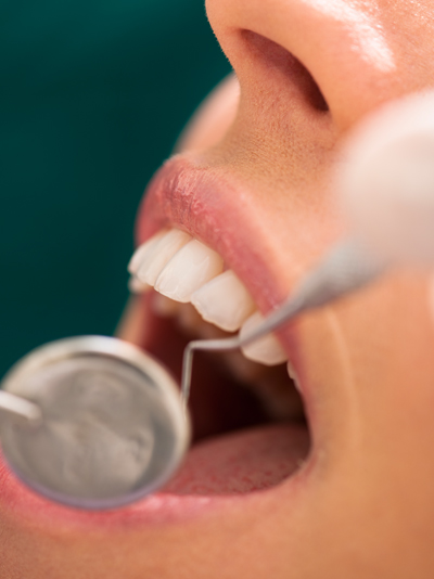 Periodontal Maintenance in Murfressboro, TN